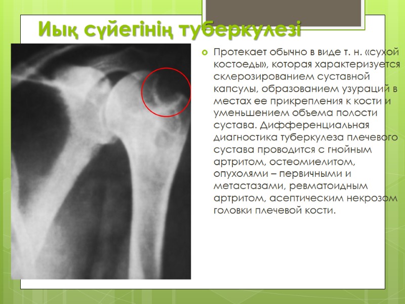 Иық сүйегінің туберкулезі Протекает обычно в виде т. н. «сухой костоеды», которая характеризуется склерозированием